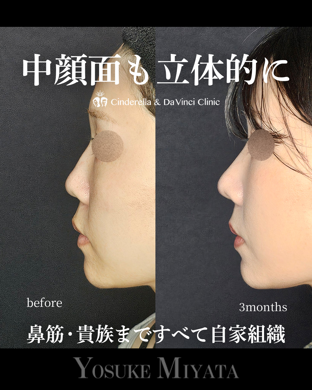 中顔面陥没を改善の画像