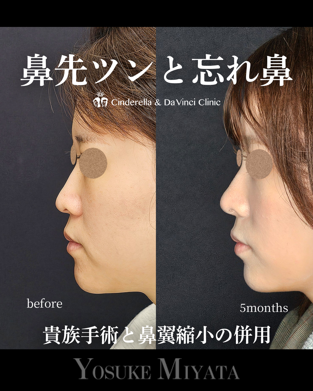 鼻先ツンと忘れ鼻の画像