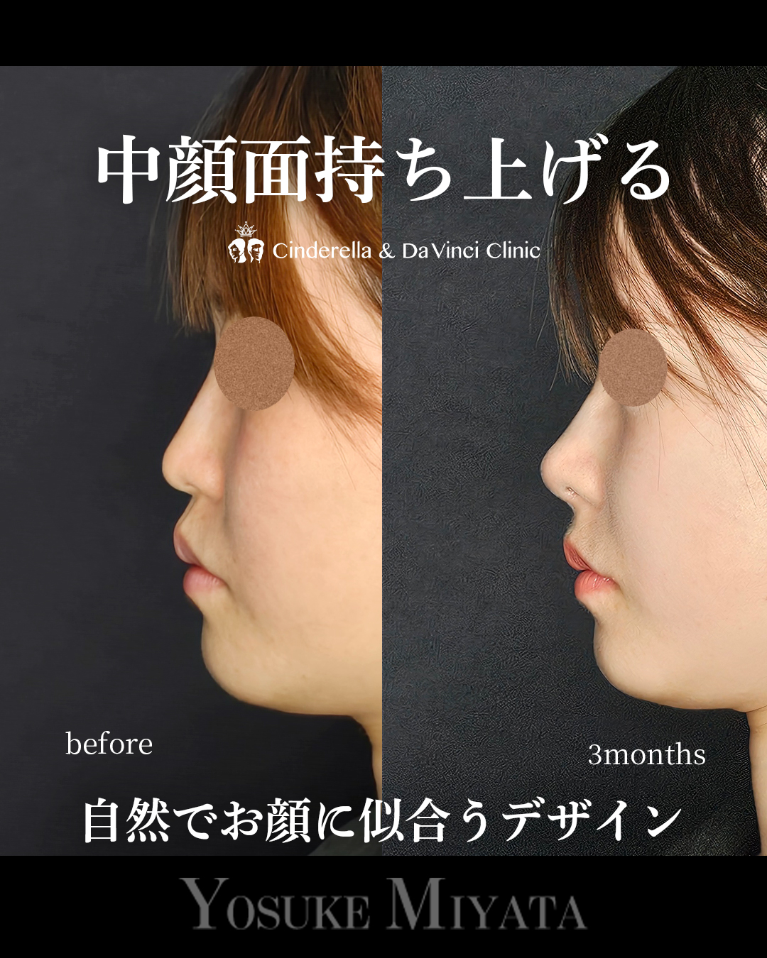 自然で似合う鼻の画像