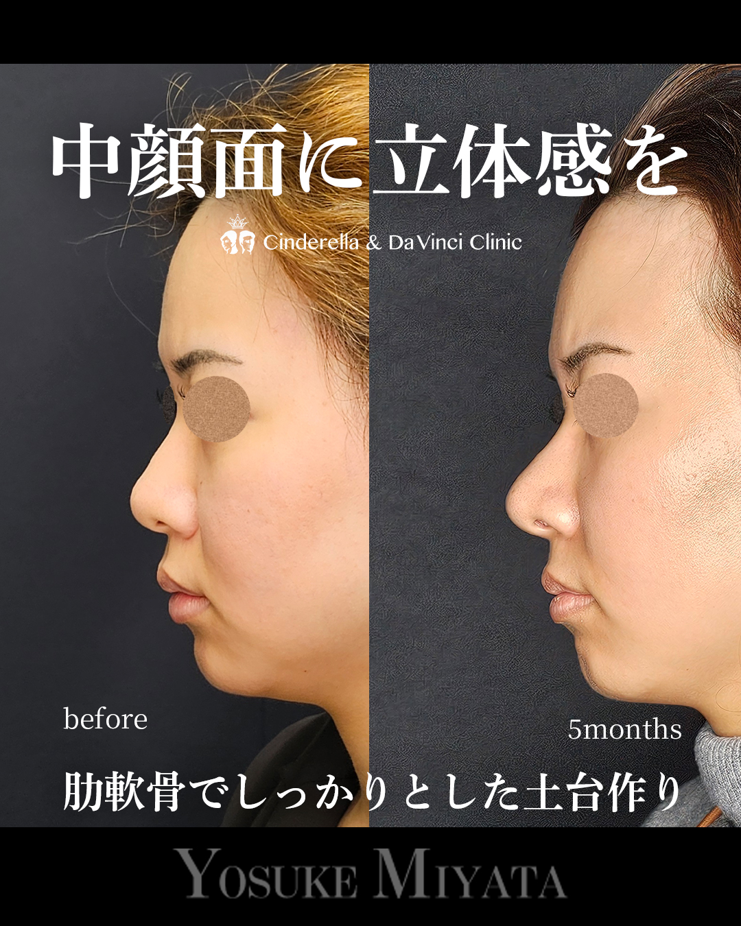 中顔面に立体感をの画像