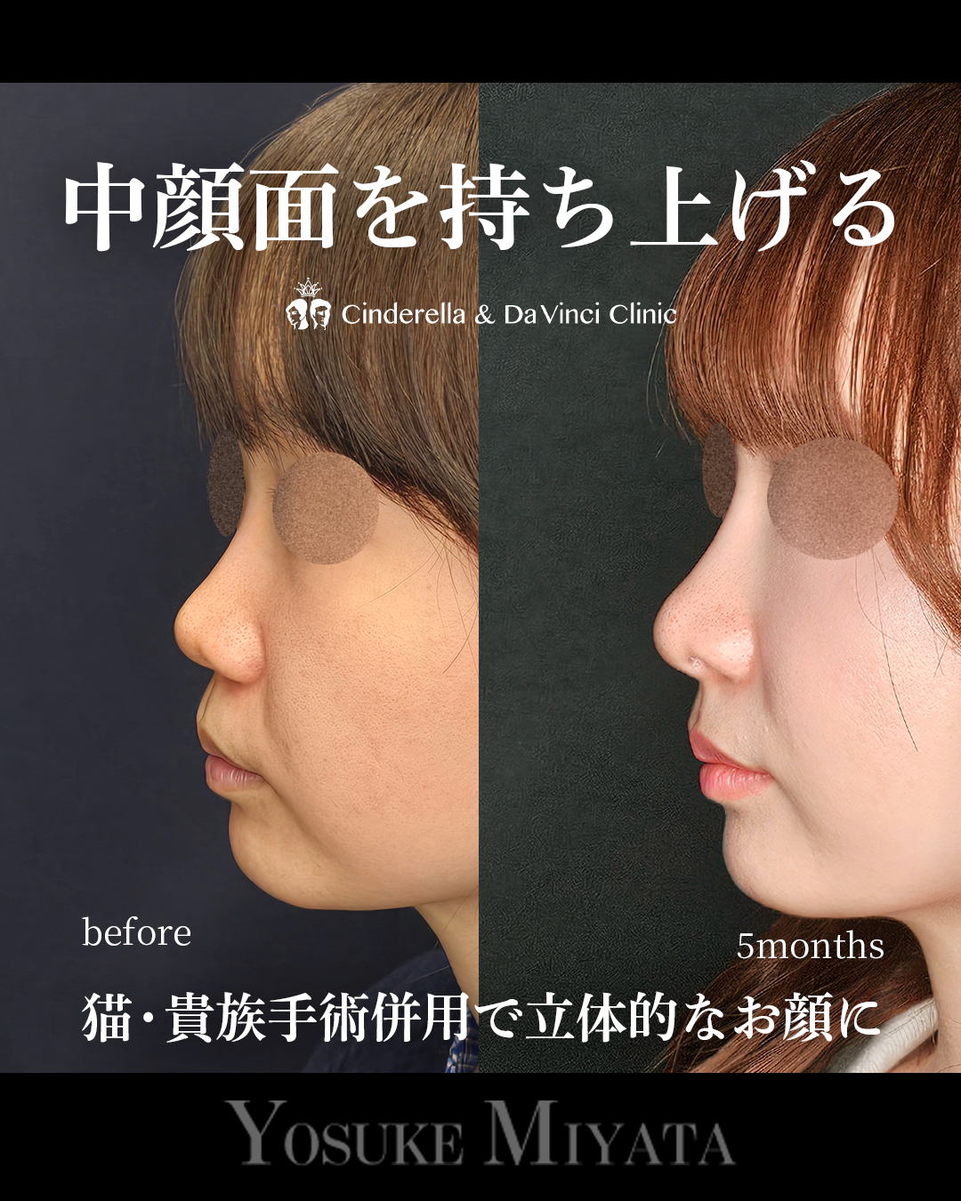 猫手術と貴族手術併用の画像