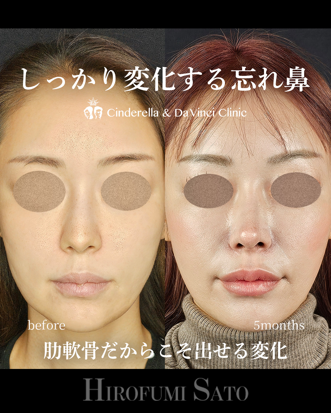 肋軟骨で鼻整形の画像