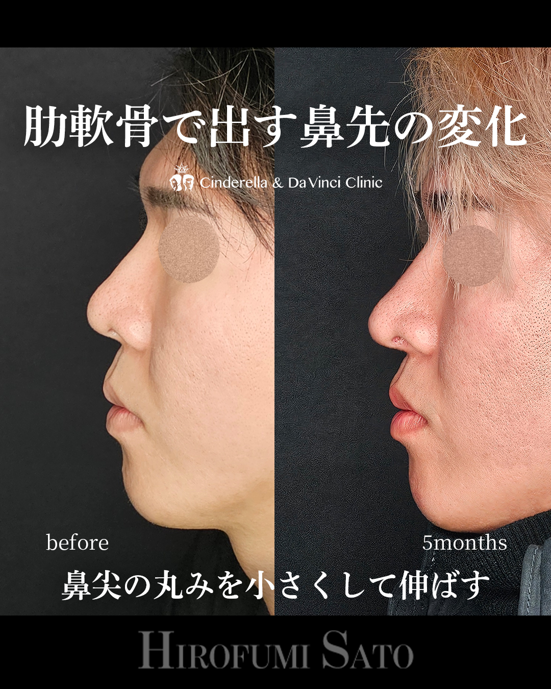 鼻先整えるの画像