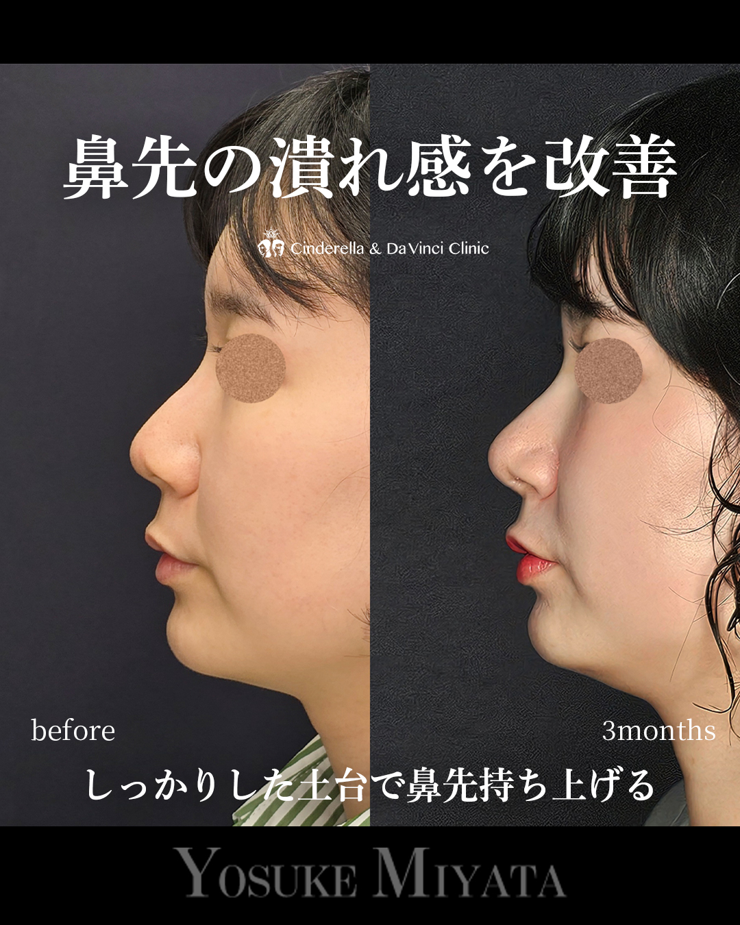 潰れ感の改善の画像