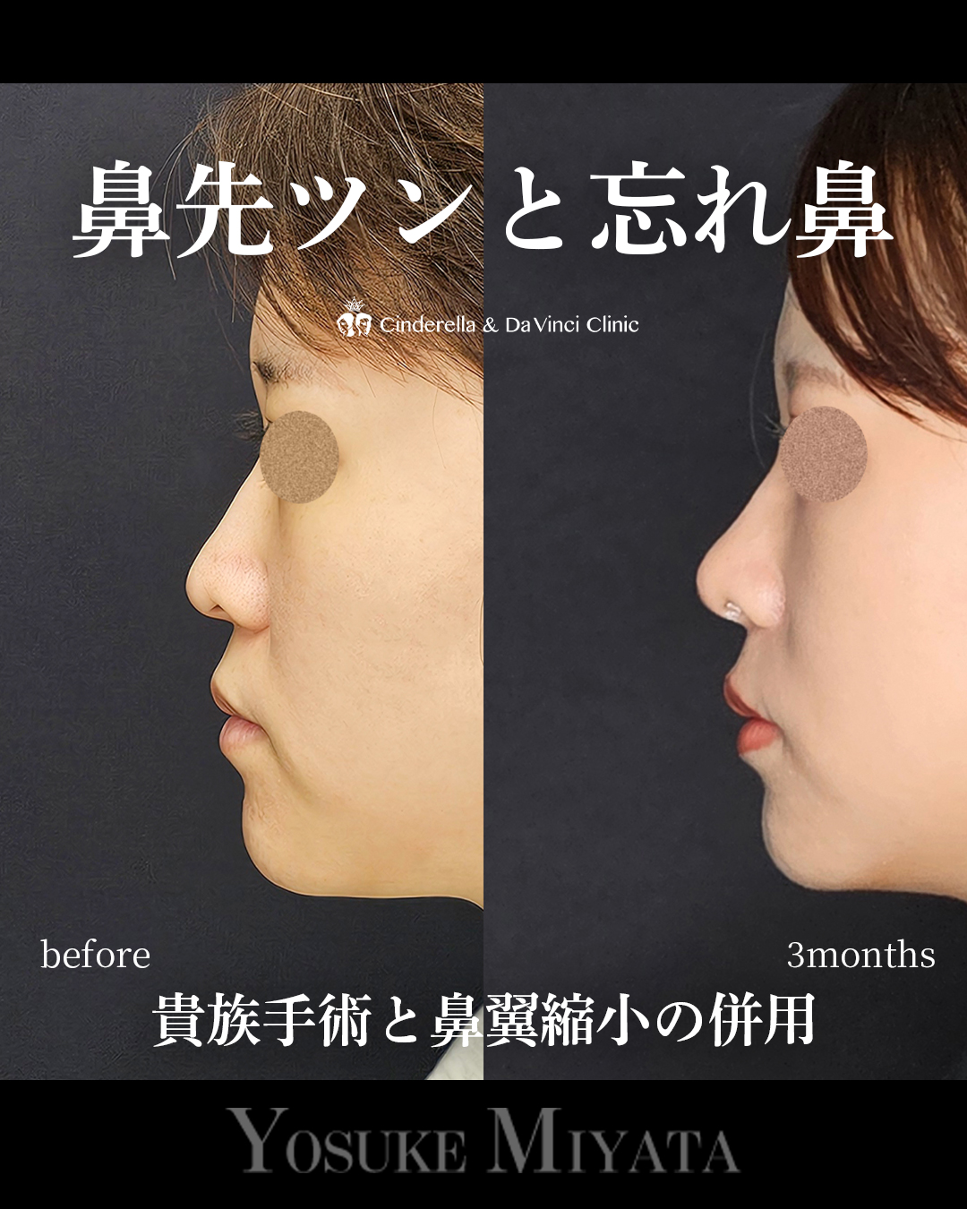 鼻先ツンと忘れ鼻の画像