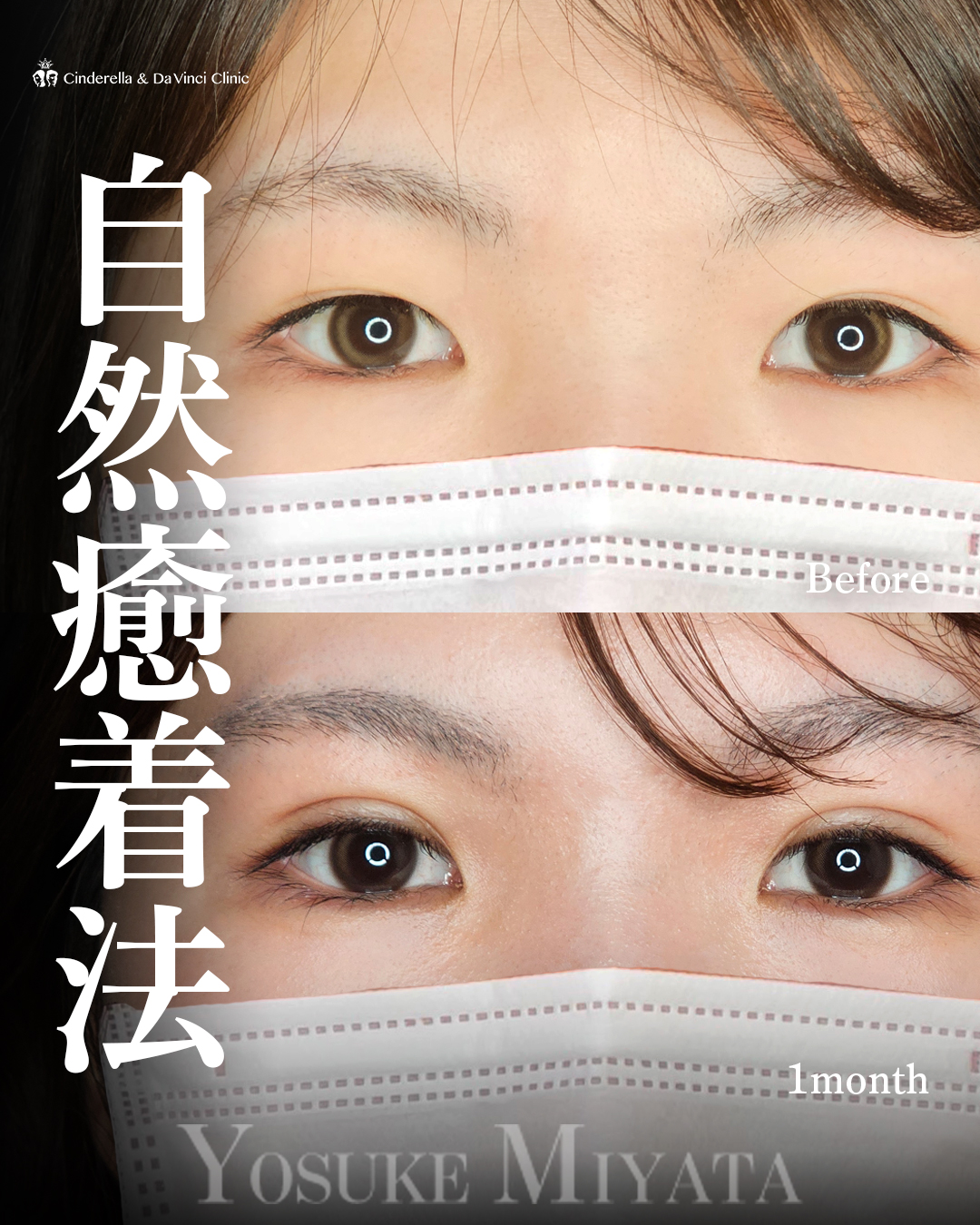 はっきり二重の画像