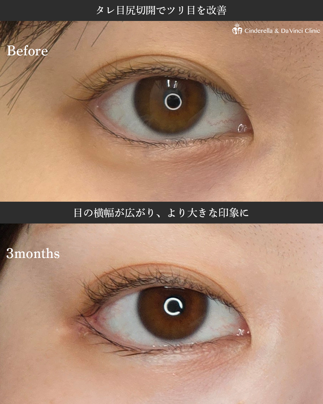 タレ目にするの画像