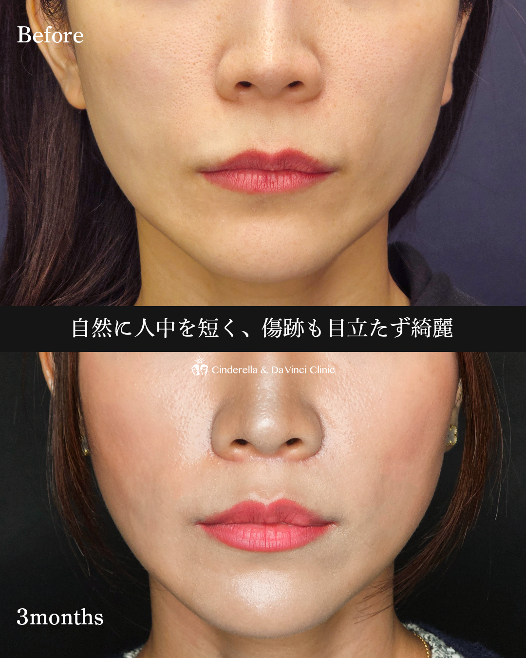 自然に人中短くの画像