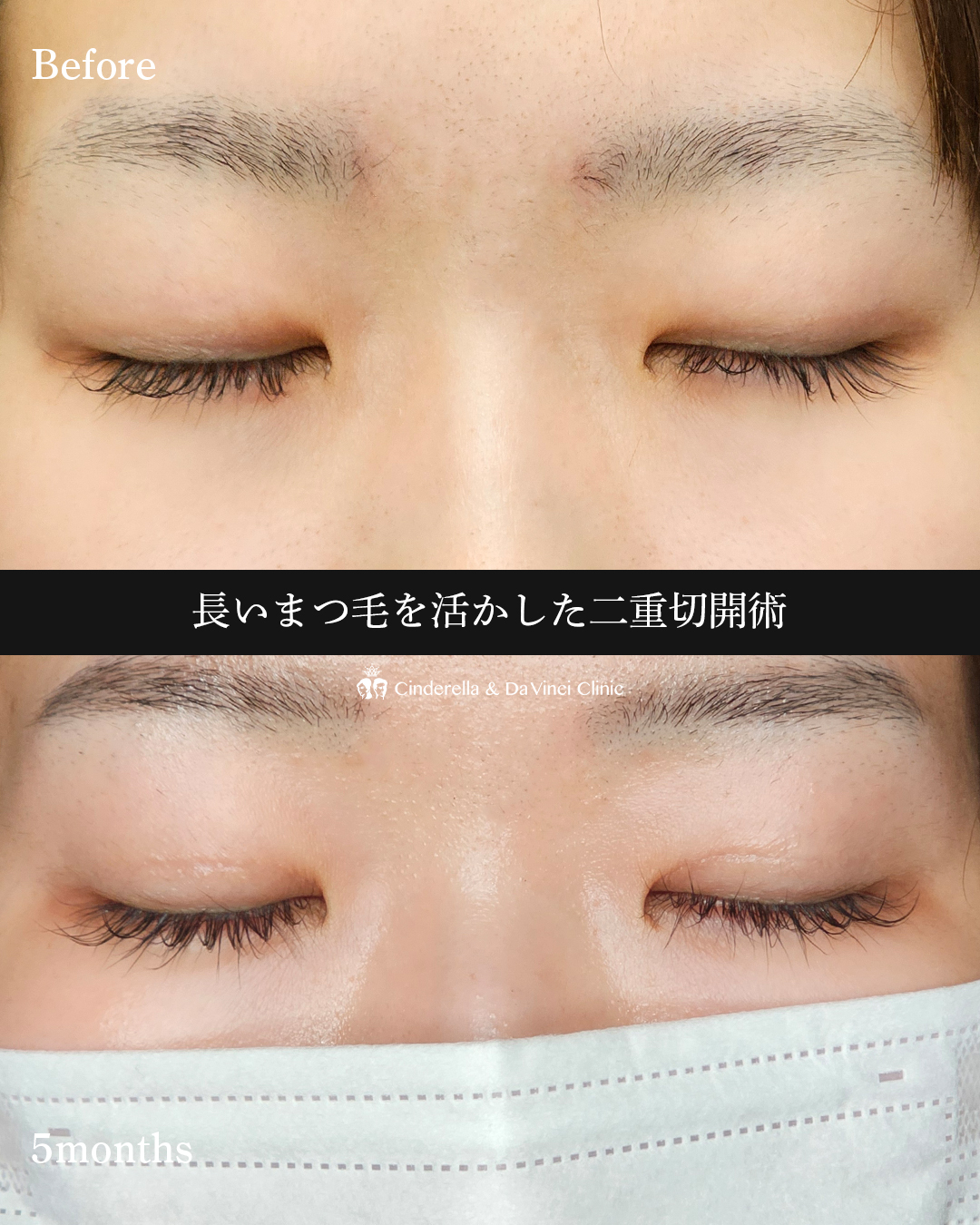 きれいな二重切開の画像