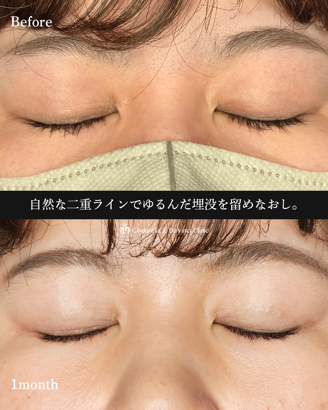 自然な二重の画像