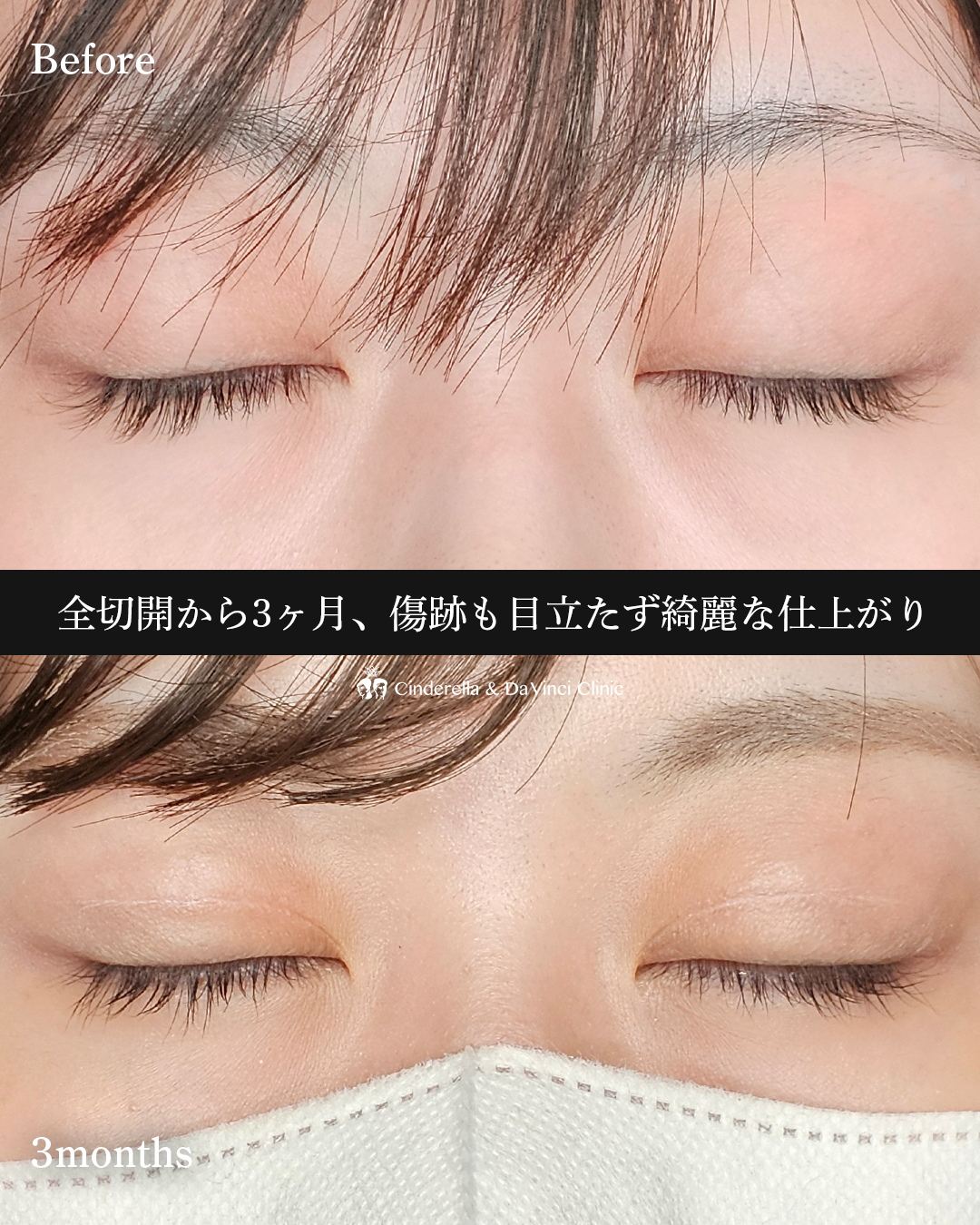 くっきり二重の画像