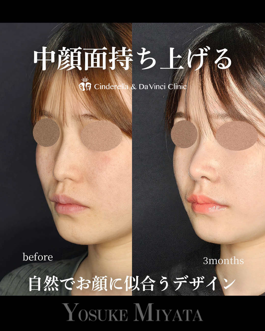 自然で似合う鼻の画像