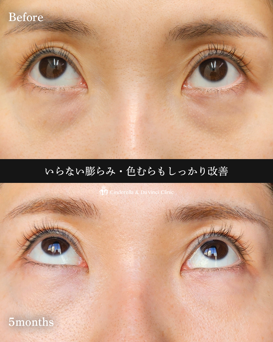 クマは裏ハムラ法での画像