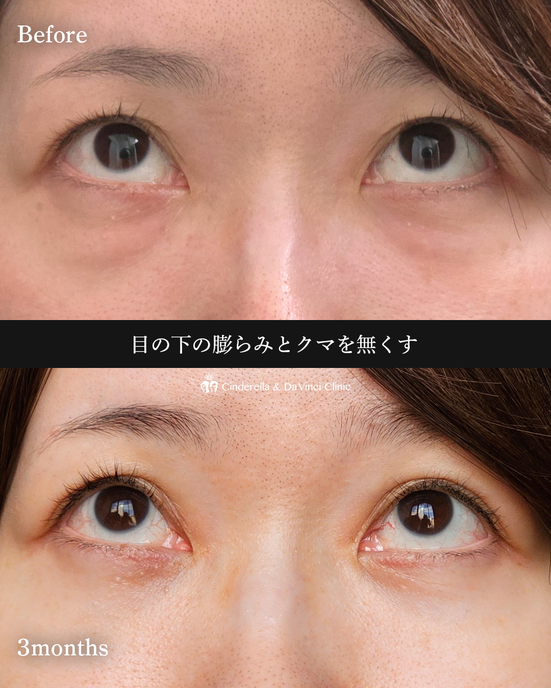 疲れ顔改善の画像