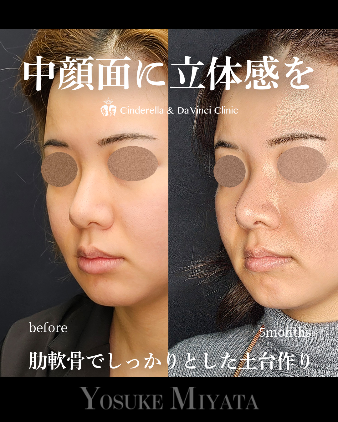 中顔面に立体感をの画像