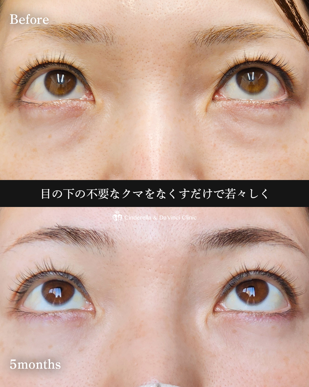 自然なクマ取りの画像