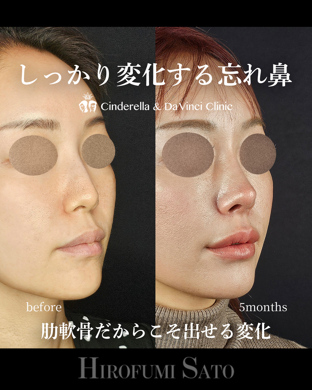 肋軟骨で鼻整形の画像