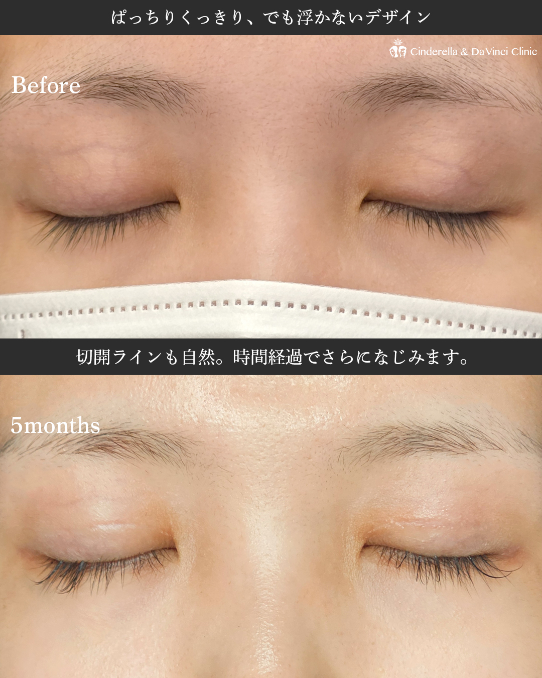切開でつくる二重の画像
