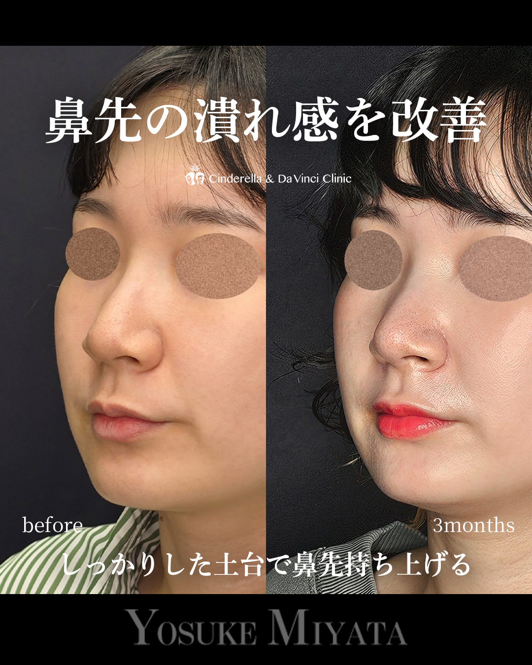 潰れ感の改善の画像