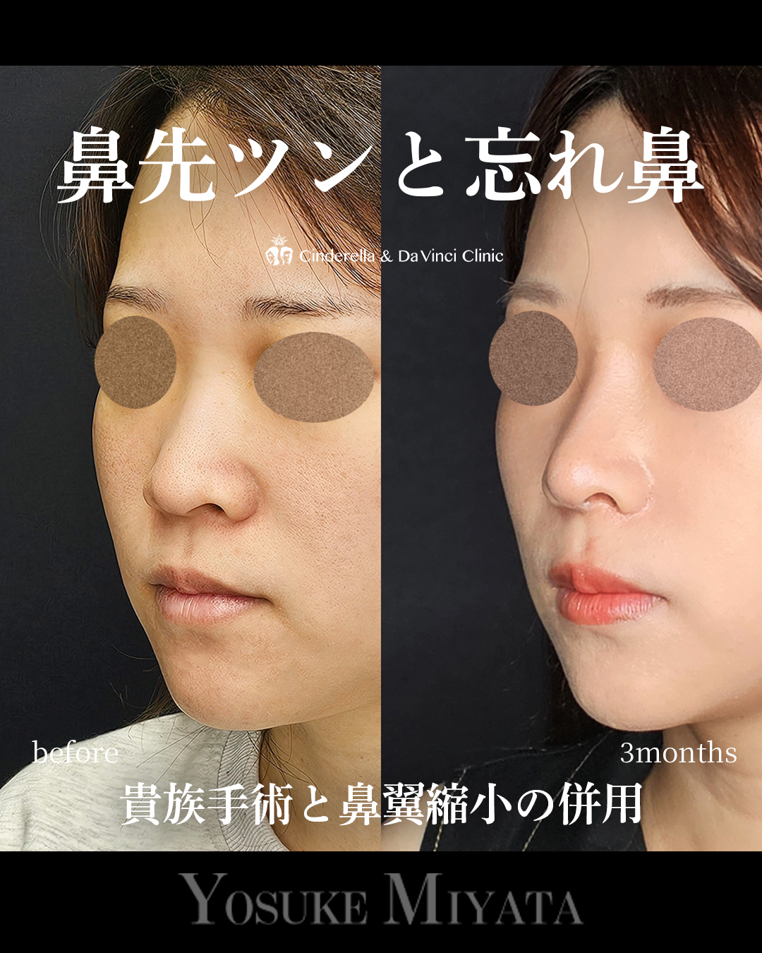 鼻先ツンと忘れ鼻の画像