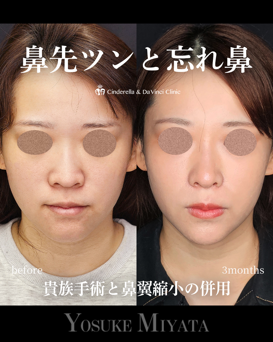 鼻先ツンと忘れ鼻の画像