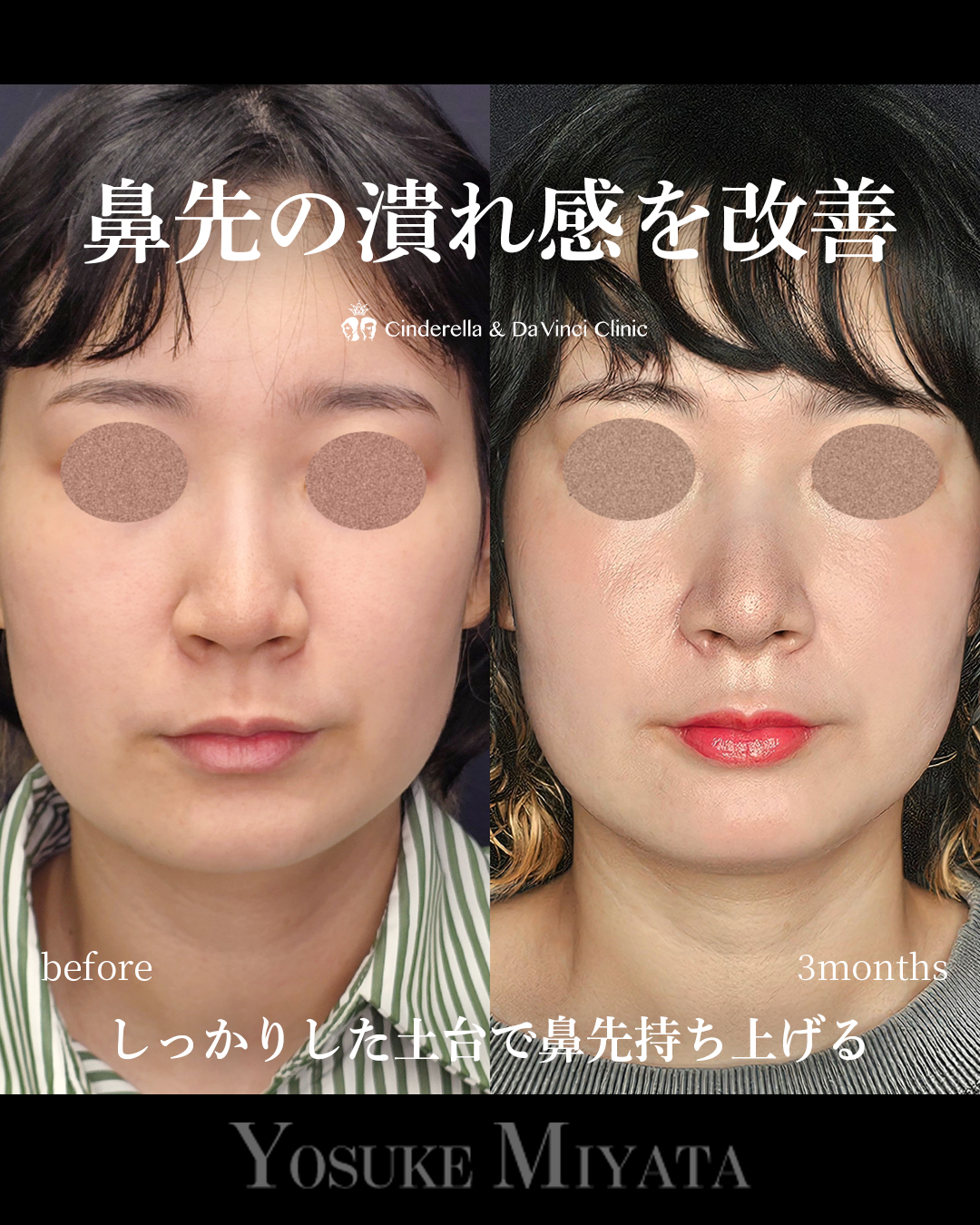 潰れ感の改善の画像