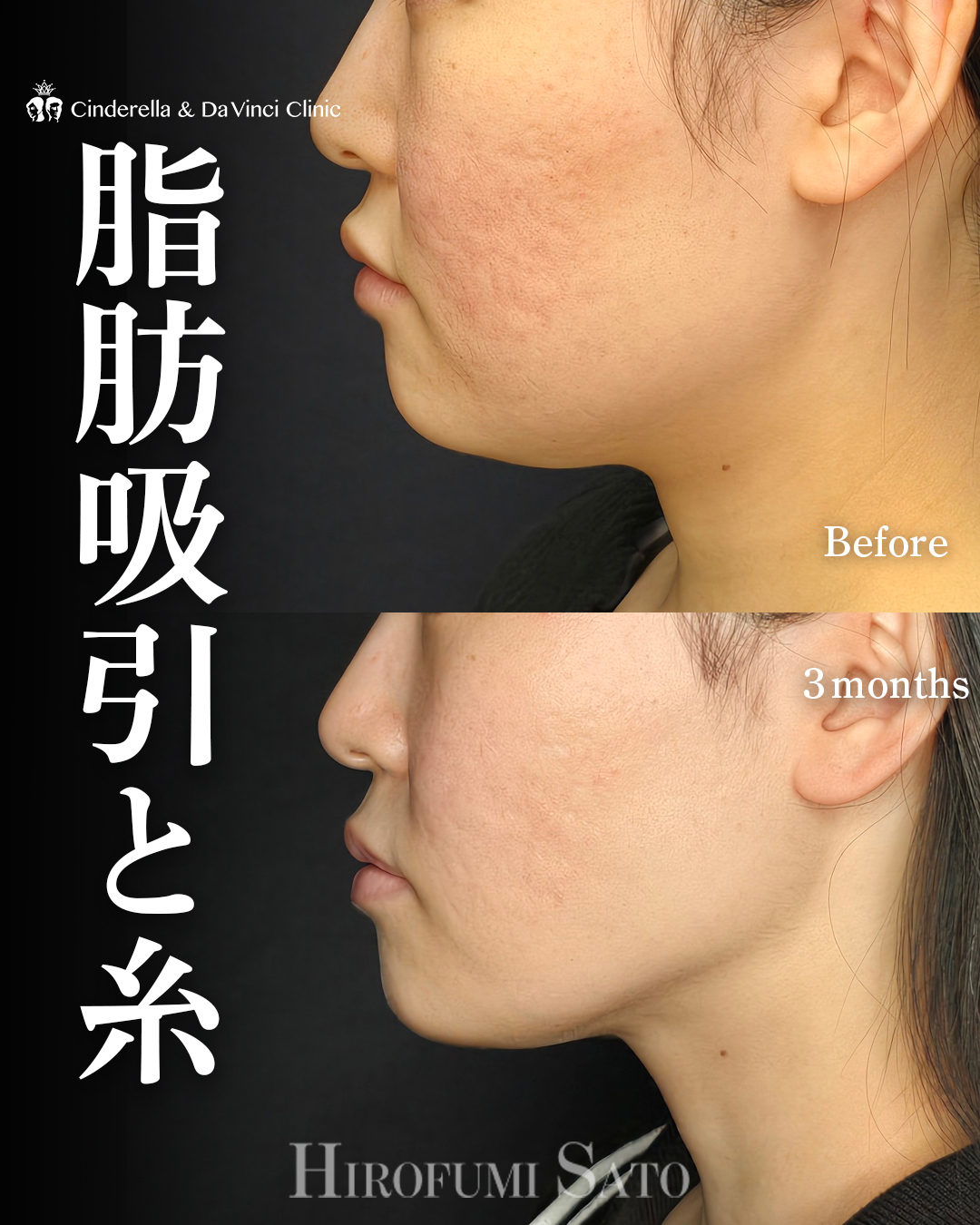 顔の脂肪吸引と糸の画像