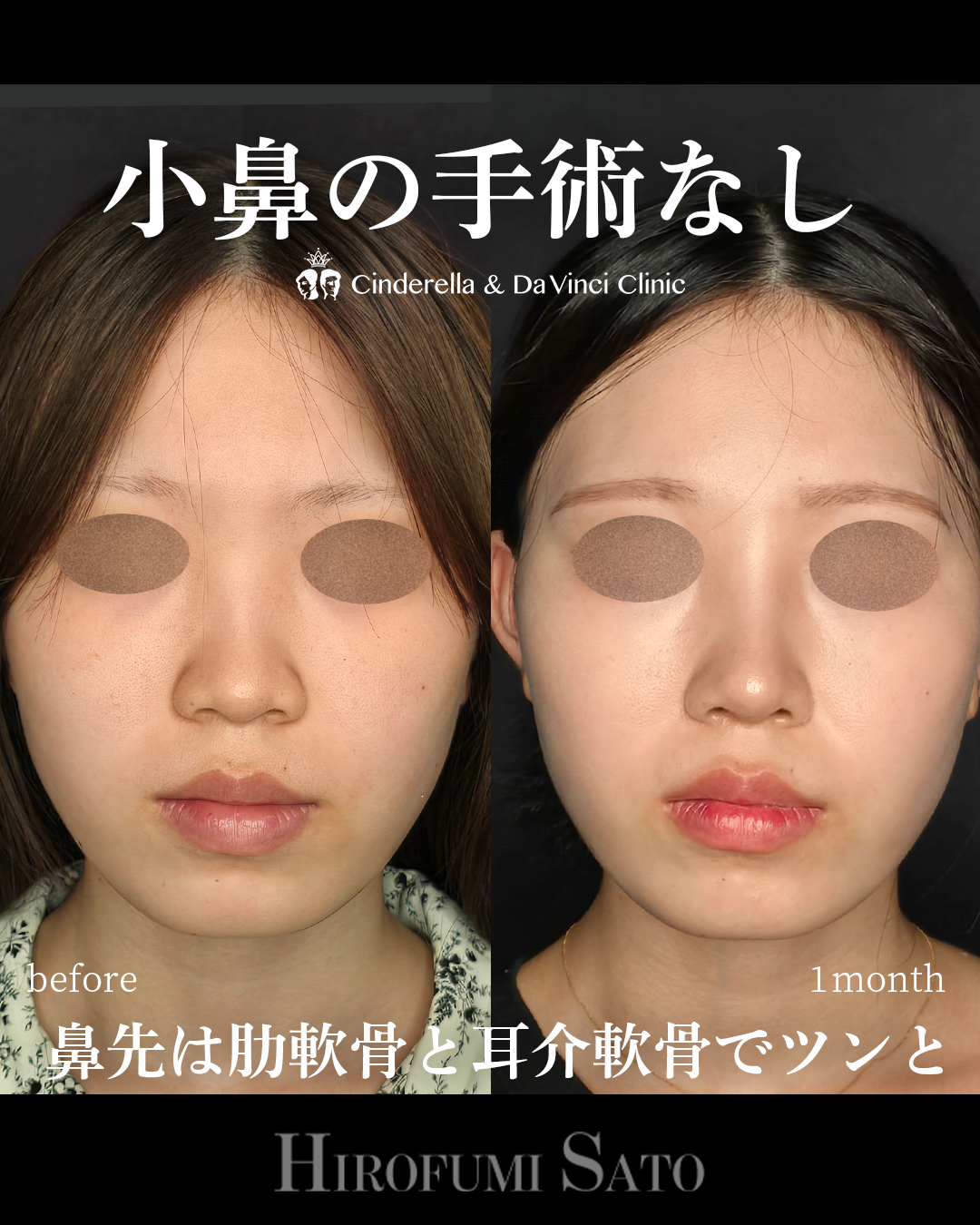 小鼻縮小なしで小鼻を小さくの画像