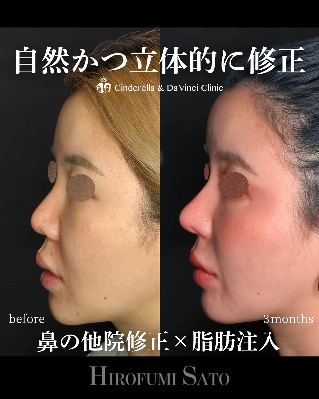 脂肪注入と鼻整形を同時にの画像