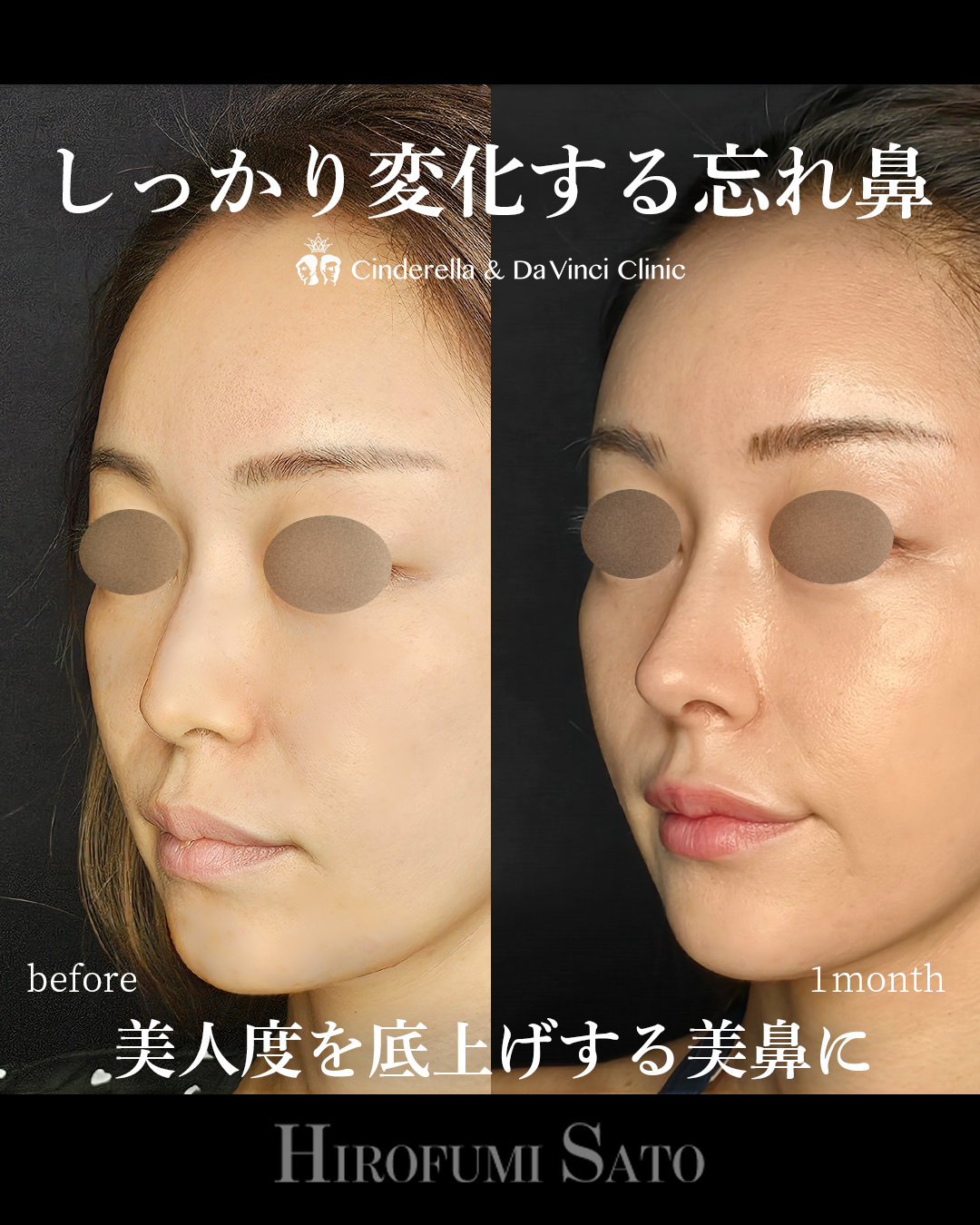 肋軟骨で鼻整形の画像