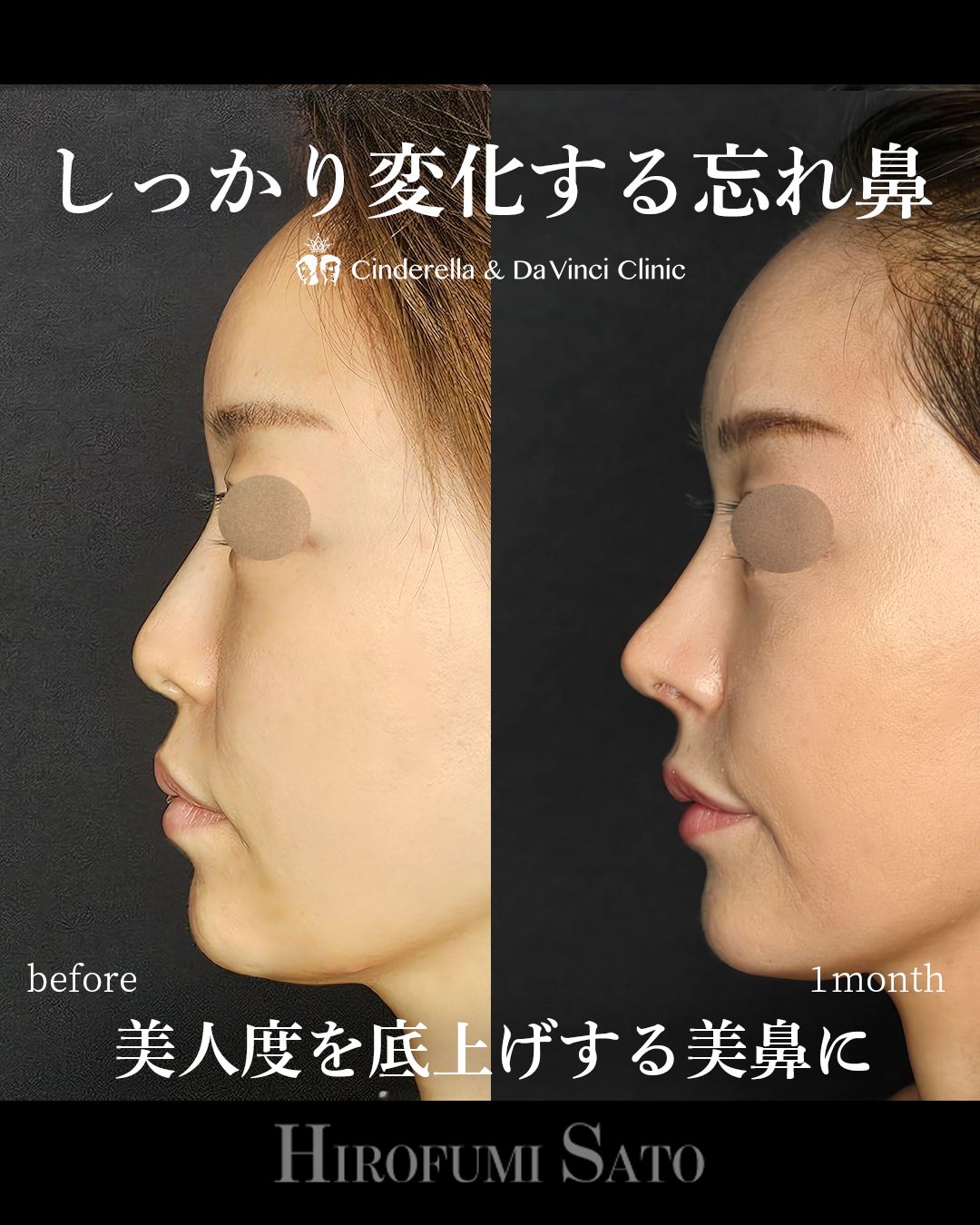 肋軟骨で鼻整形の画像