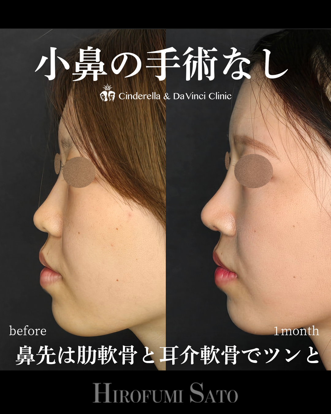 小鼻縮小なしで小鼻を小さくの画像
