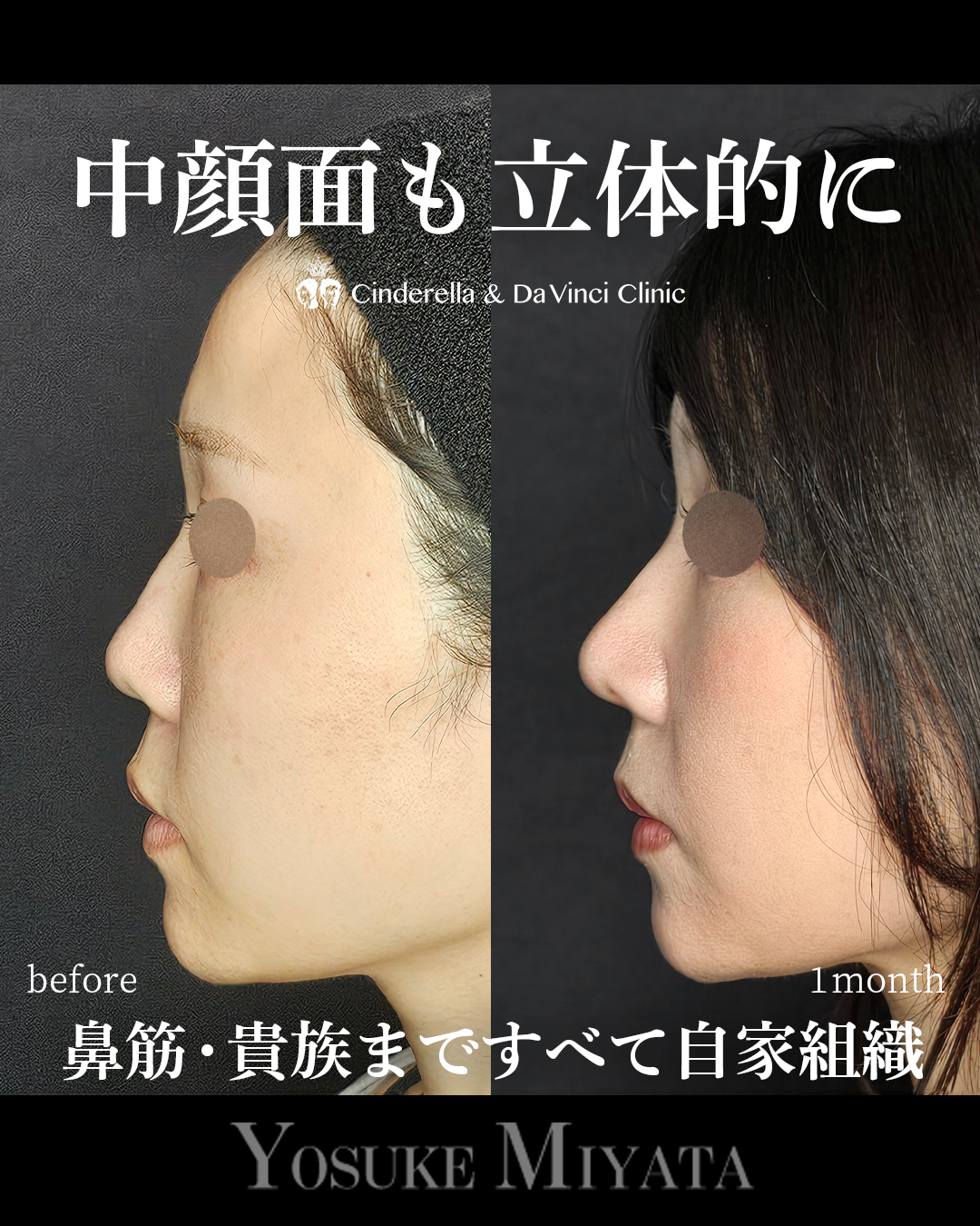中顔面陥没を改善の画像
