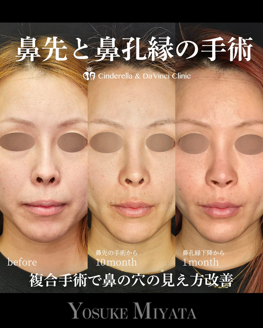 鼻整形で鼻の穴を見えなくするの画像