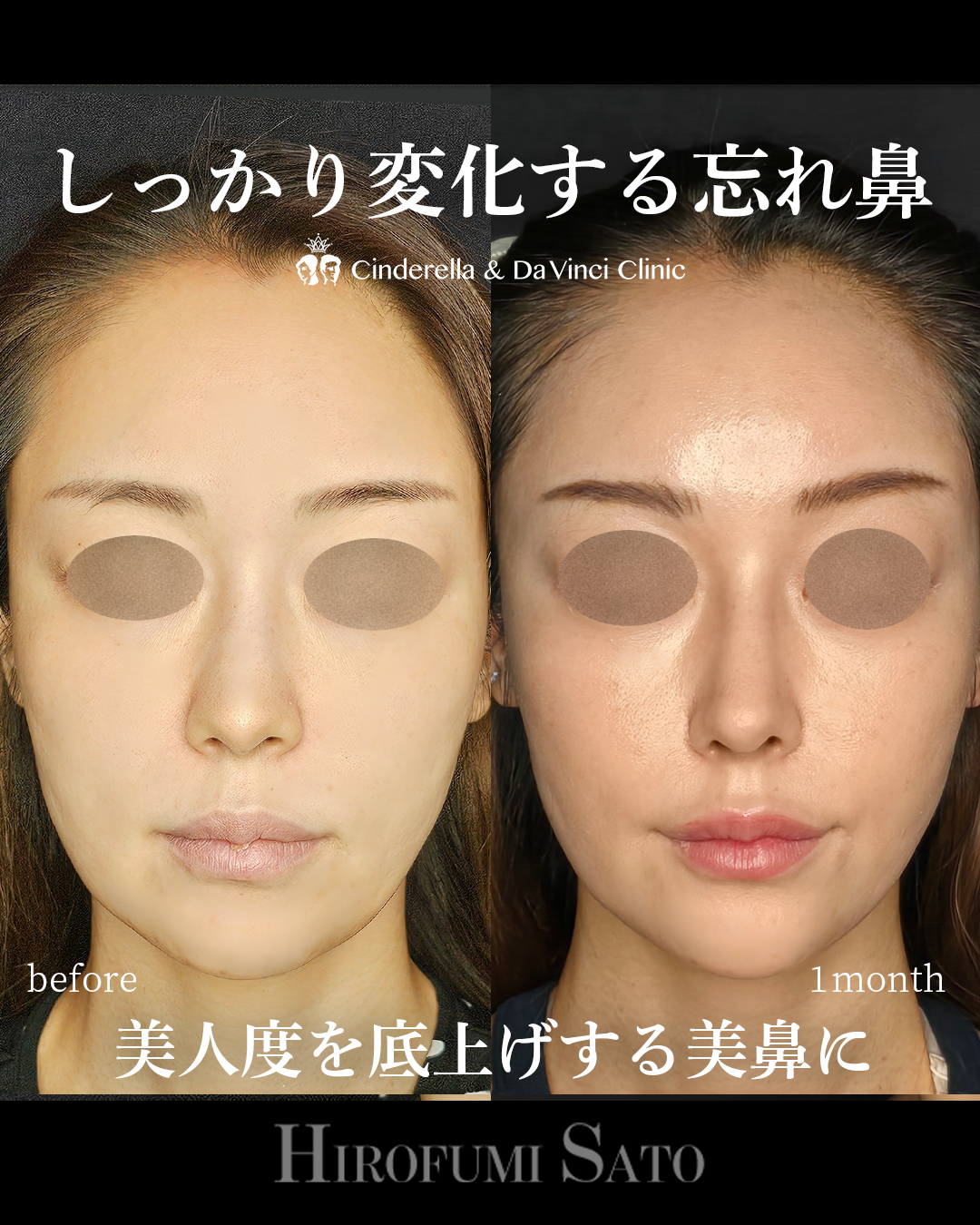 肋軟骨で鼻整形の画像