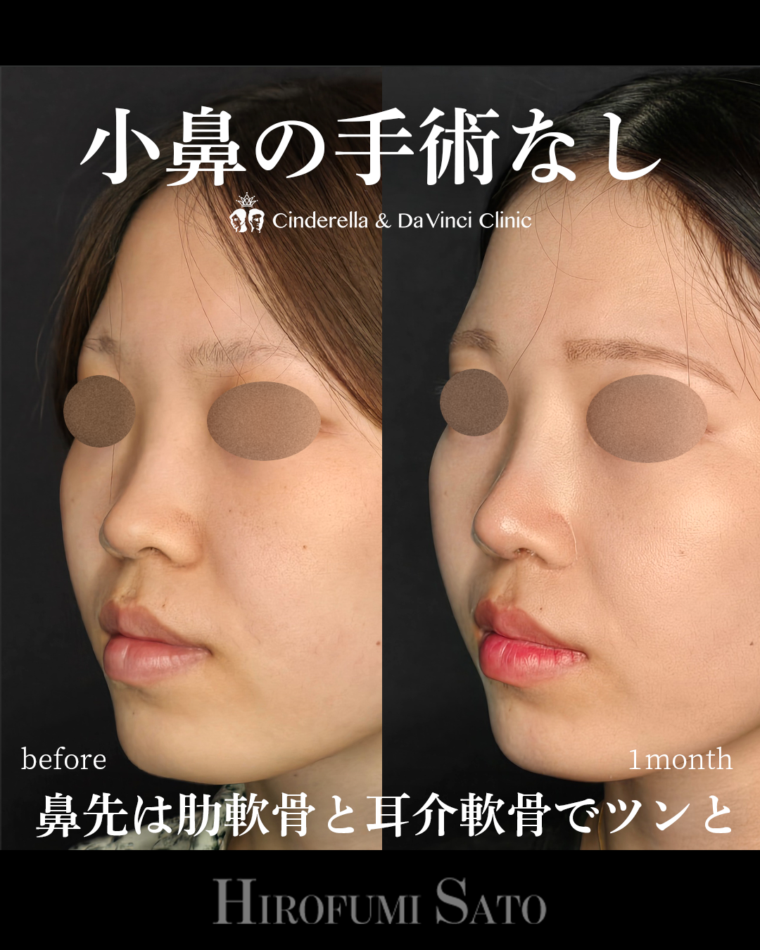 小鼻縮小なしで小鼻を小さくの画像
