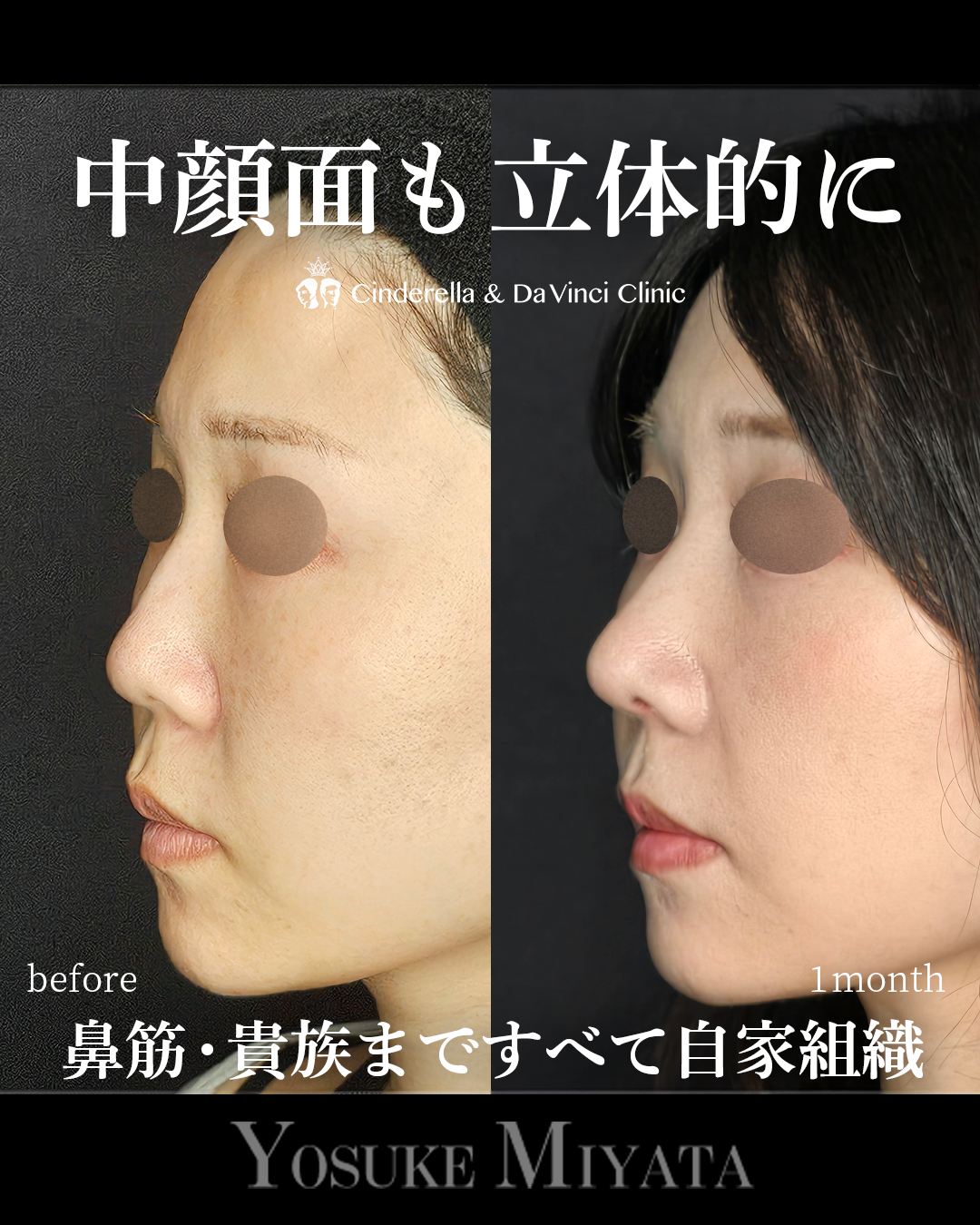中顔面陥没を改善の画像