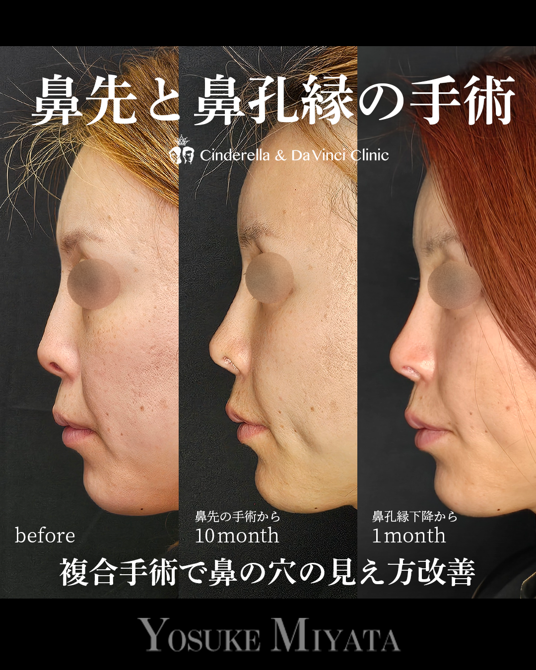 鼻整形で鼻の穴を見えなくするの画像