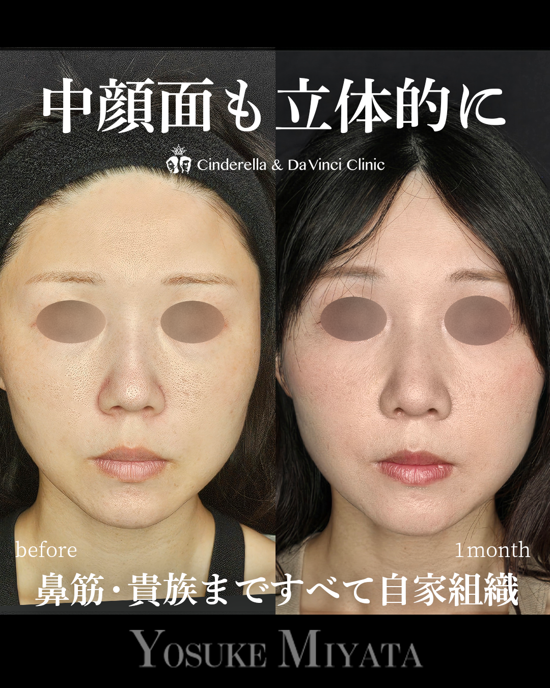 中顔面陥没を改善の画像