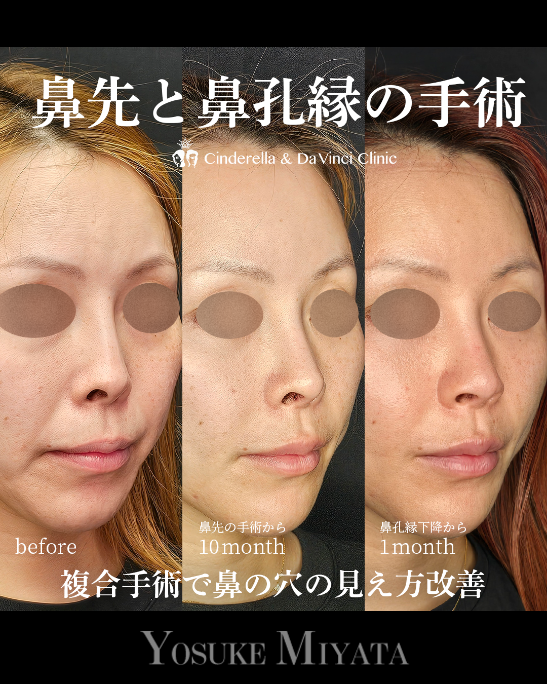 鼻整形で鼻の穴を見えなくするの画像