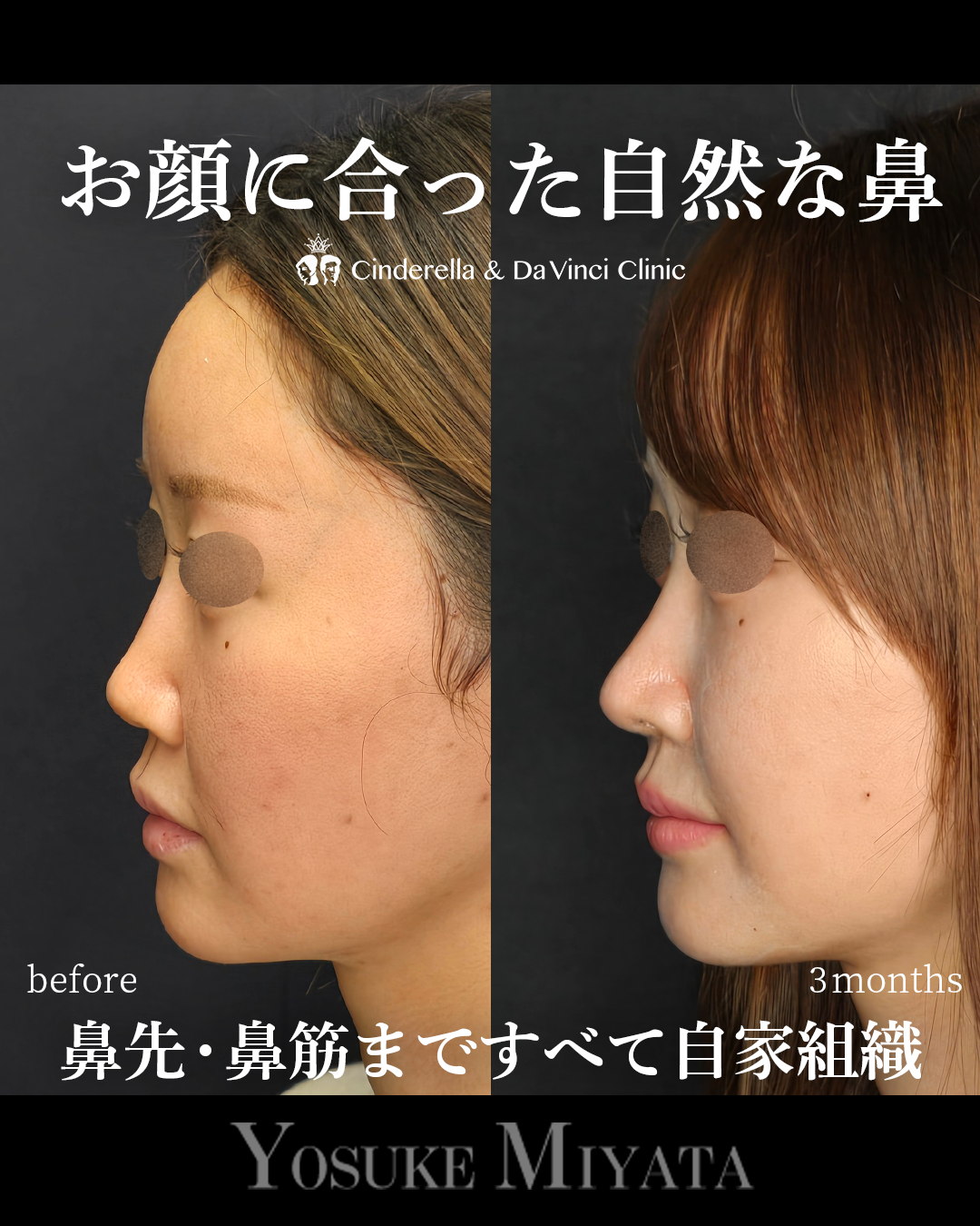 顔になじむ鼻整形の画像