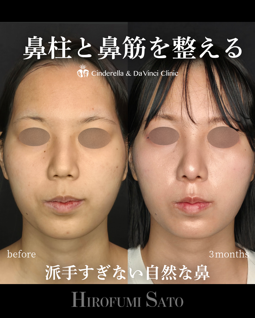 鼻柱と鼻筋を整えるの画像