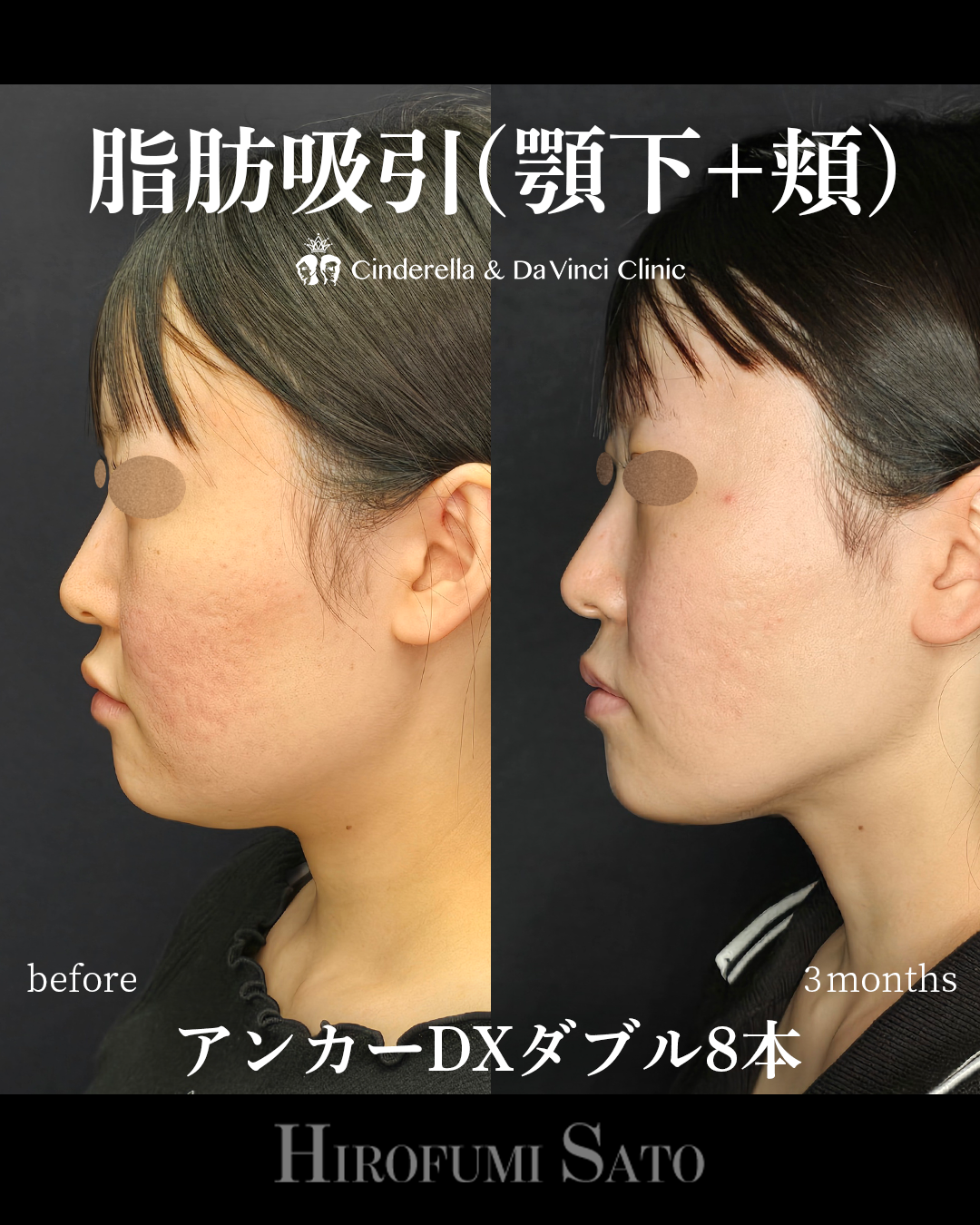 顔の脂肪吸引と糸の画像