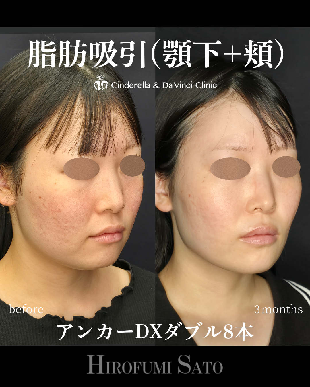 顔の脂肪吸引と糸の画像