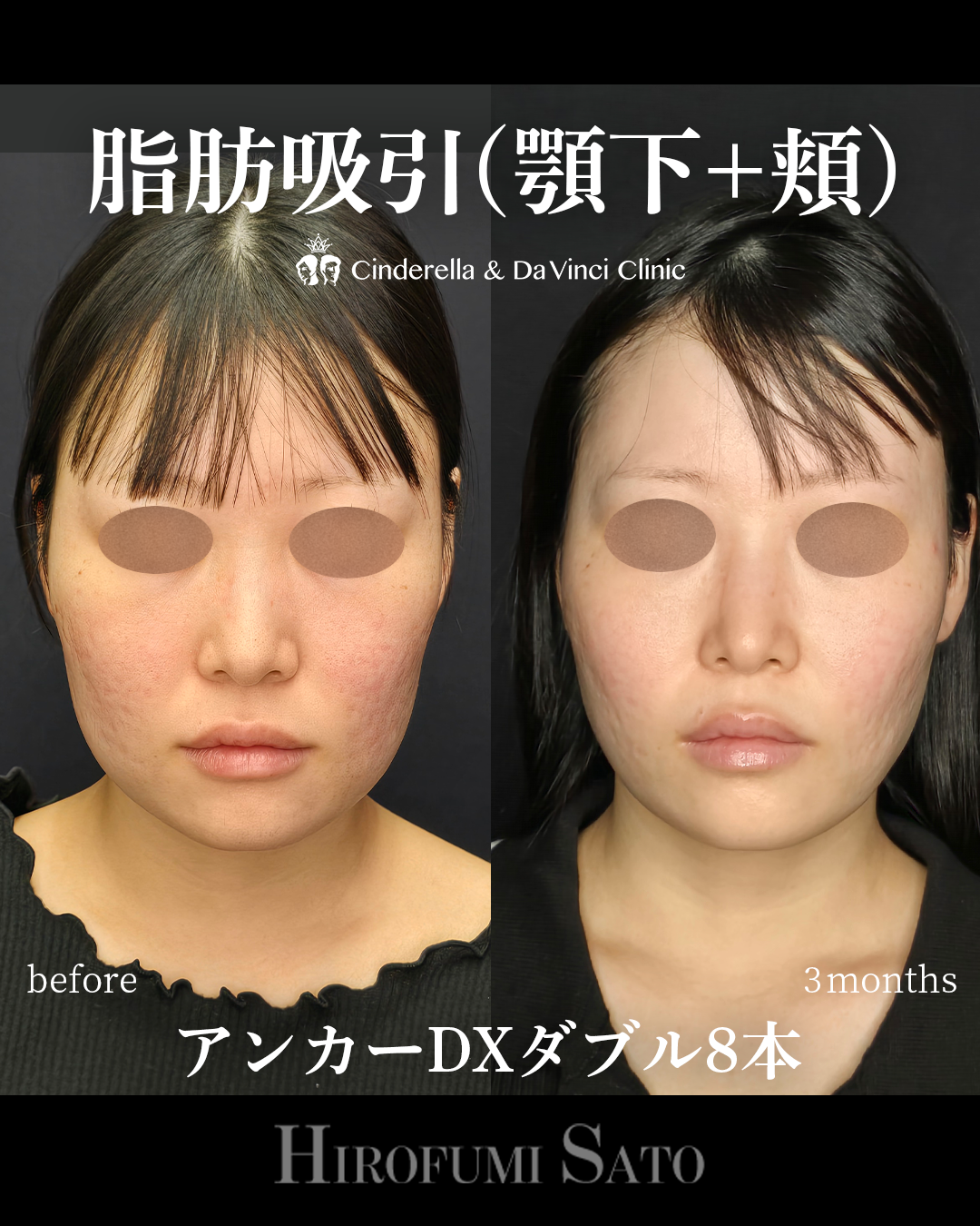 顔の脂肪吸引と糸の画像