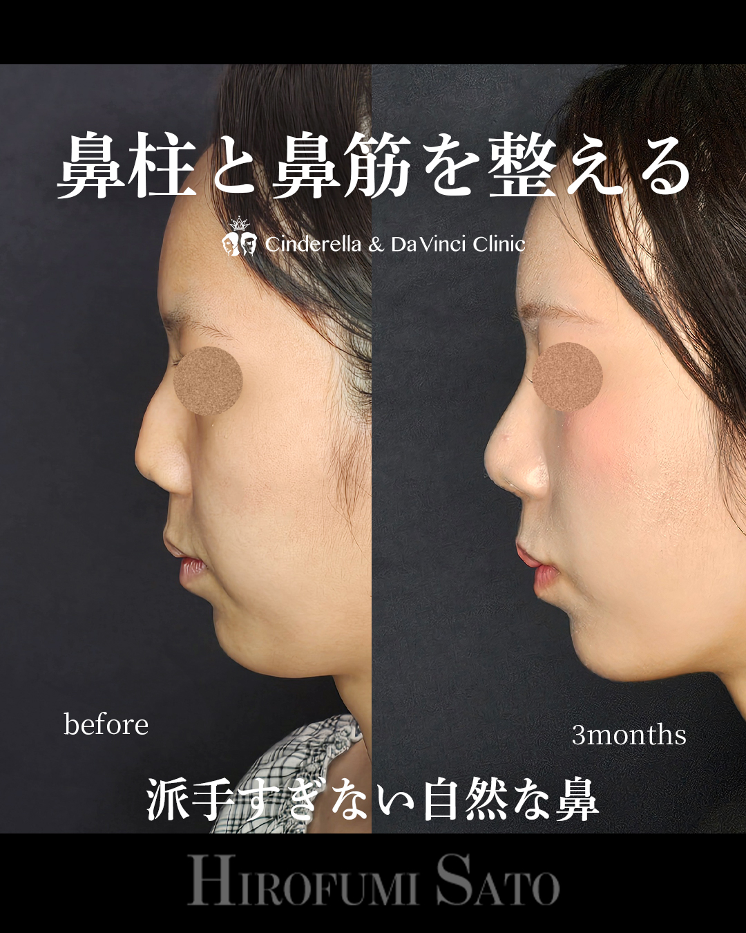 鼻柱と鼻筋を整えるの画像