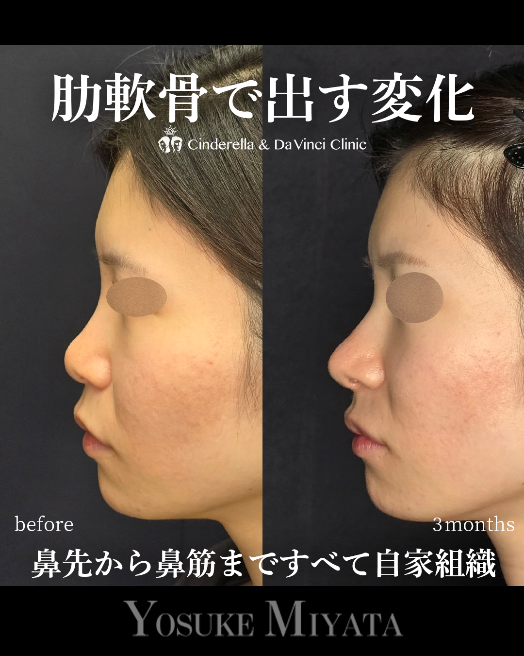 肋軟骨の鼻整形の画像