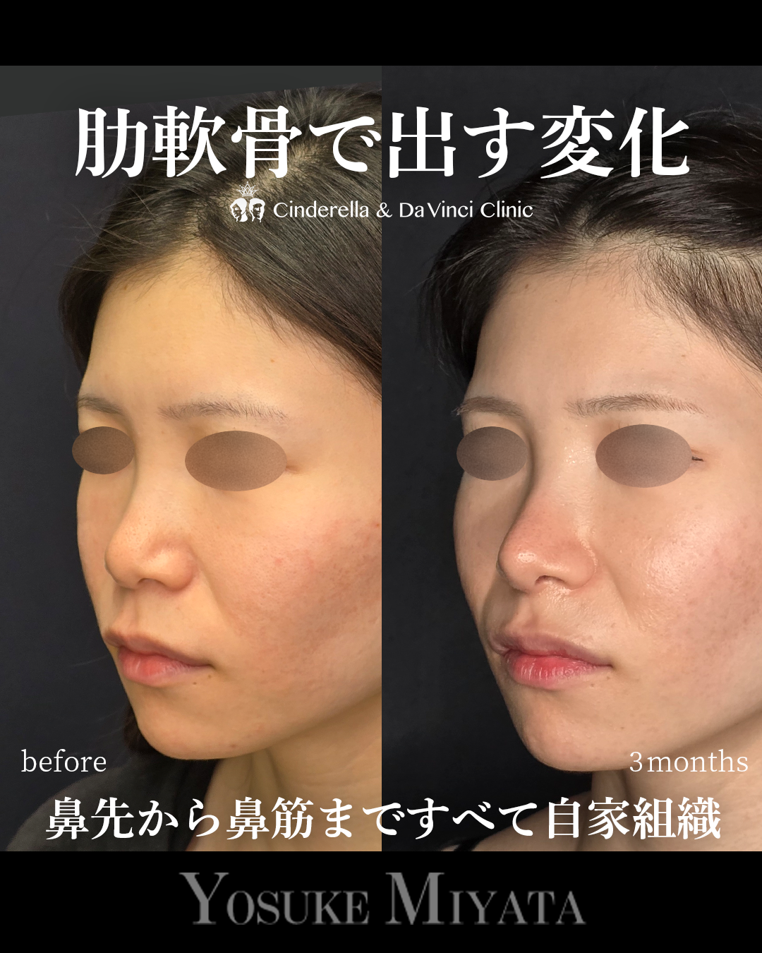 肋軟骨の鼻整形の画像