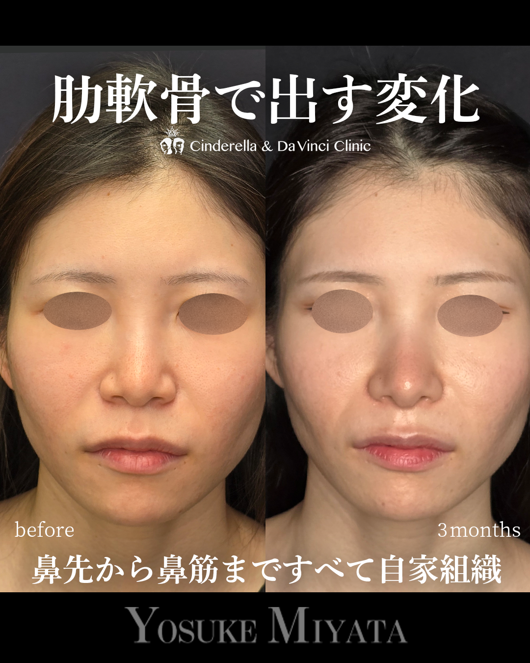 肋軟骨の鼻整形の画像