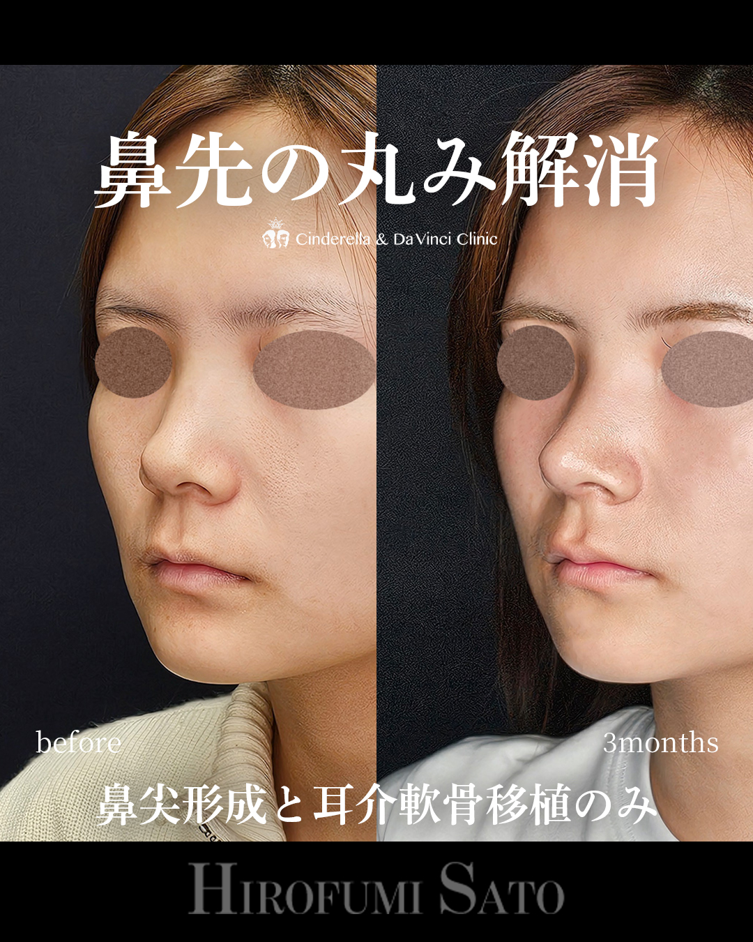 鼻先の丸み改善の画像